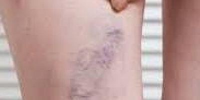 VARİS TEDAVİSİNDE YENİ YÖNTEMLE ÇAĞ ATLAYAN  BEUN ARAŞTIRMA  HASTANESİ