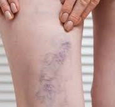 VARİS TEDAVİSİNDE YENİ YÖNTEMLE ÇAĞ ATLAYAN  BEUN ARAŞTIRMA  HASTANESİ